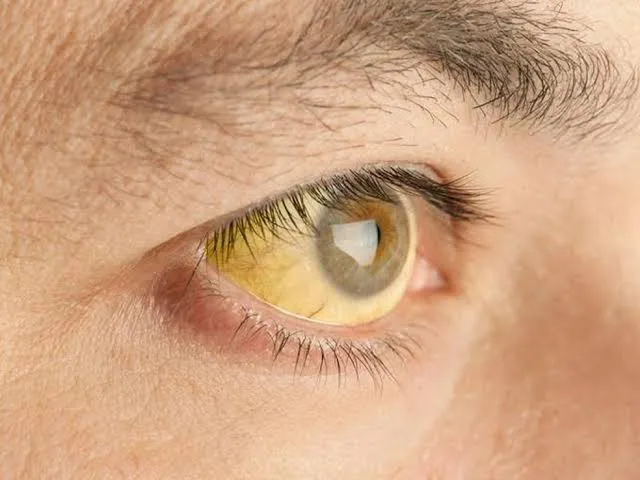 Terapia adaptada diminui mortes por febre amarela em 84%